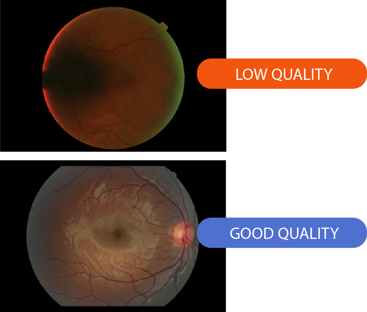 Retina image quality analysis